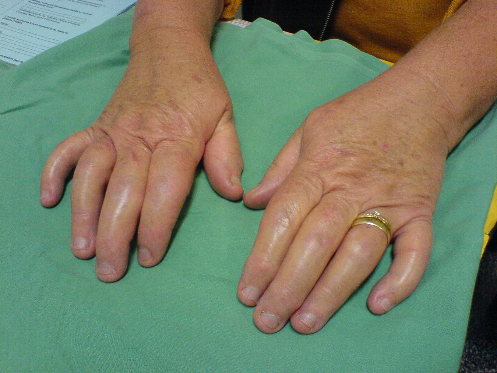 Psoriatic arthritis